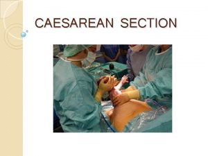 CAESAREAN SECTION SOURCE https www slideshare netmijjuscaes areansection8764420