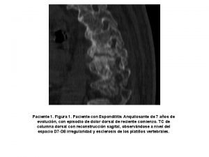 Paciente 1 Figura 1 Paciente con Espondilitis Anquilosante