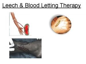 Leech therapy