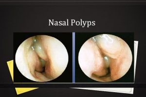 Difference between antrochoanal polyp and ethmoidal polyp
