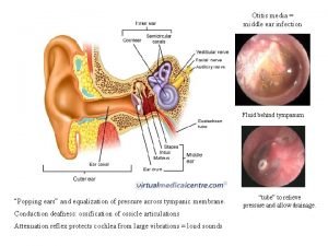 Otitis media middle ear infection Fluid behind tympanum