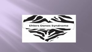 EhlersDanlos Syndrome EDS Is a connective tissue disorder