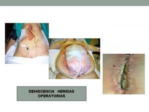 DEHISCENCIA HERIDAS OPERATORIAS INFECCIN HERIDA OPRATORIA INFECCIN BACTERIANA