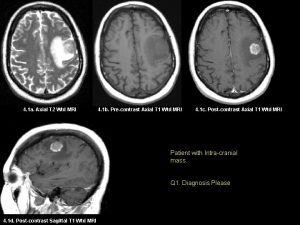 Abnormal mri