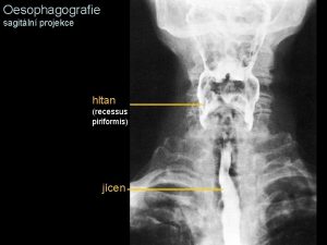 Oesophagografie sagitln projekce hltan recessus piriformis jcen Oesophagografie