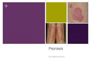 Psoriasis By Marissa Miuccio Definition n What is