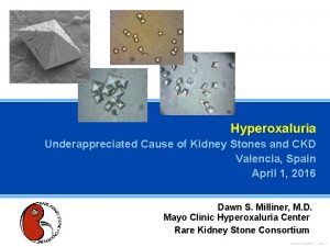 Hyperoxaluria Underappreciated Cause of Kidney Stones and CKD