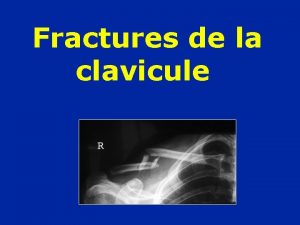 Fractures de la clavicule Fractures de la clavicule