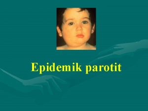 Epidemik parotit Epidemik parotit Trifi Epidemik parotit az