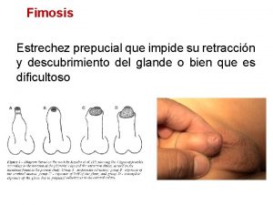 Grados de fimosis