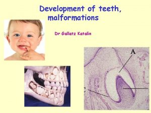 Development of teeth malformations Dr Gallatz Katalin DEVELOPMENT