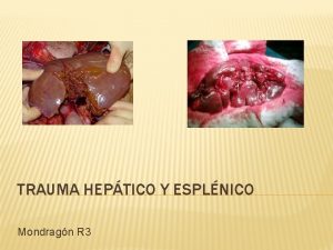 TRAUMA HEPTICO Y ESPLNICO Mondragn R 3 TRAUMA