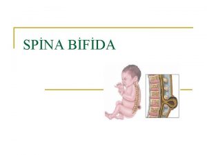 SPNA BFDA Spina bifida omurgada oluan bir bozukluktur