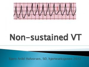 Nsvt ekg