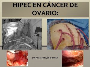 HIPEC EN CNCER DE OVARIO Dr Javier Meja