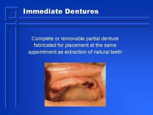 Immediate Dentures Complete or removable partial denture fabricated
