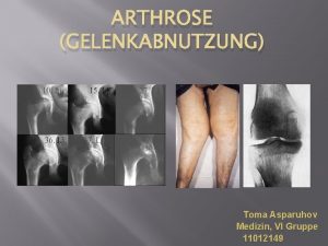 ARTHROSE GELENKABNUTZUNG Toma Asparuhov Medizin VI Gruppe 11012149