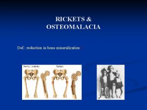 Rickets x ray findings