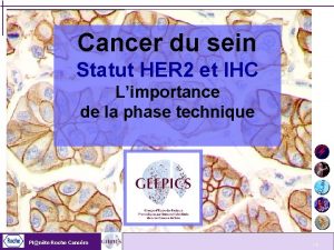 Cancer du sein Statut HER 2 et IHC