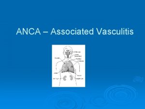 ANCA Associated Vasculitis The Discovery of AntiNeutrophil Cytoplasmic