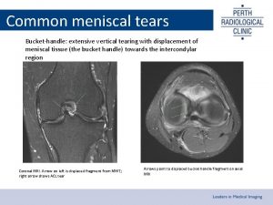 Common meniscal tears Buckethandle extensive vertical tearing with