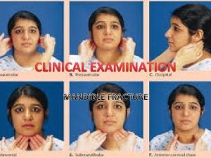 CLINICAL EXAMINATION MANDIBLE FRACTURE Classification of Mandible fracture