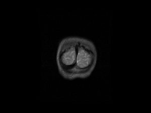 Calcarine sulcus Cerebellar hemisphere Superior sagittal sinus Posterior