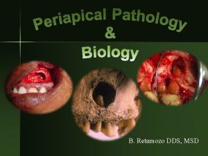 Condensing osteitis