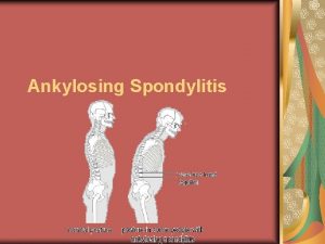 Ankylosing Spondylitis ETIOLOGY PATHOPHYSIOLOGY Ankylosing spondylitis is a