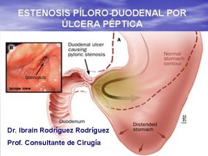 ESTENOSIS PLORODUODENAL POR LCERA PPTICA Dr Ibrain Rodrguez