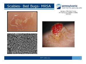 Scabies Bed Bugs MRSA Bureau of Workers Comp