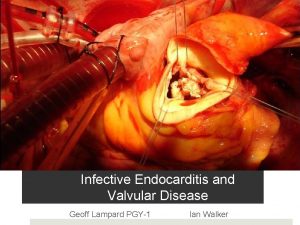 Infective Endocarditis and Valvular Disease Geoff Lampard PGY1