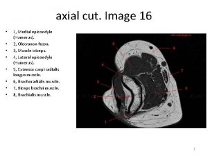 axial cut Image 16 1 Medial epicondyle Humerus