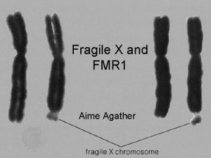 Fragile X and FMR 1 Aime Agather Mental