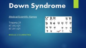 Down Syndrome MedicalScientific Names Trisomy 21 47 XX