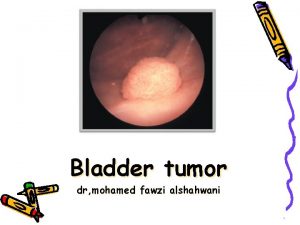 Bladder tumor dr mohamed fawzi alshahwani 1 facts