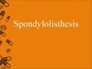 Spondylolisthesis Spondylolisthesis Definition The term Spondylolisthesis refers to