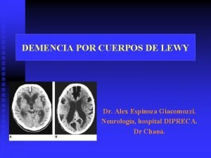 DEMENCIA POR CUERPOS DE LEWY Dr Alex Espinoza