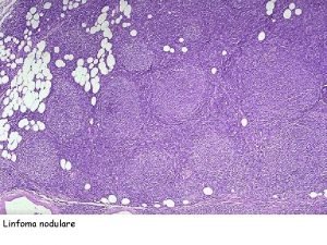 Linfoma nodulare Tumore benigno Anaplasia simile al tessuto