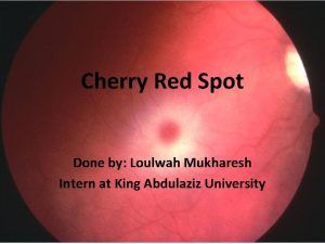 Dd of cherry red spot