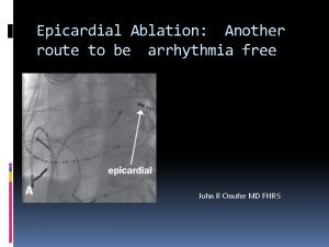 Epicardial Ablation Another route to be arrhythmia free