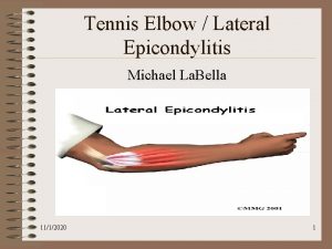 Tennis Elbow Lateral Epicondylitis Michael La Bella 1112020