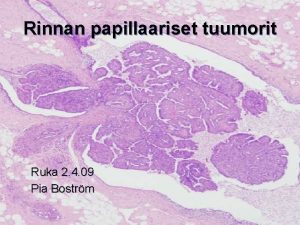 Intraduktaalinen papillooma