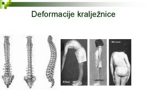 Deformacije kraljenice Kineziterapijski postupci kod kifoza n n