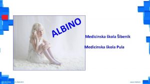 Albino osobe