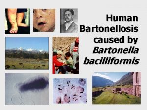 Human Bartonellosis caused by Bartonella bacilliformis 1 Henrquez