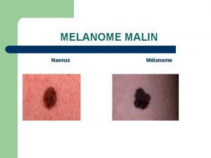 MELANOME MALIN Naevus Mlanome MELANOME MALIN l 1