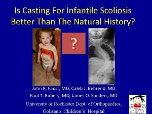 Infantile scoliosis casting Infantile scoliosis casting