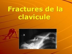 Fracture en baïonnette