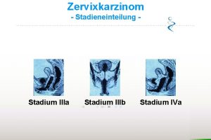 Zervixkarzinom Stadieneinteilung Stadium IIIa Stadium IIIb Stadium IVa